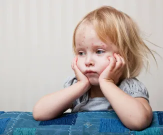 Sarampo: o que é, sintomas, tratamento e como se prevenir